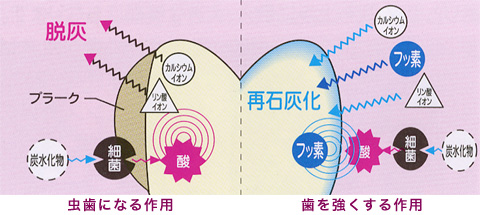 虫歯と再石灰化