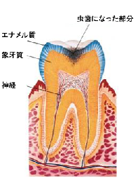 虫歯の状態