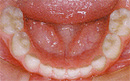 乳歯下顎