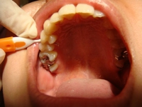 歯間ブラシ使用例（上顎）