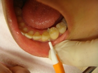 歯間ブラシ使用例（下顎）