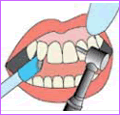 4. 機械的歯面清掃