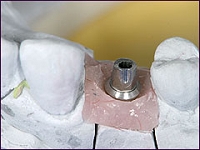 インプラント症例(1本失った場合)①術前