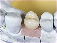 インプラント症例(1本失った場合)①術後