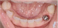 インプラント症例(1本失った場合)②術前