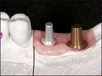 インプラント症例(奥歯を失った場合)①術前