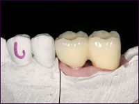 インプラント症例(奥歯を失った場合)①術後