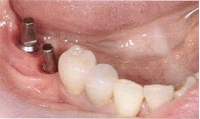インプラント症例（奥歯を失った場合）②術前