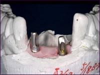インプラント症例（前歯を複数失った場合）①術前