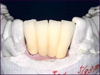 インプラント症例（前歯を複数失った場合）①術後